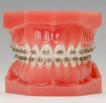 しろがね矯正歯科、姫路、矯正