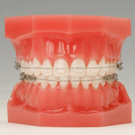 しろがね矯正歯科、姫路、矯正