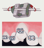 しろがね矯正歯科、姫路、矯正