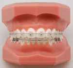 しろがね矯正歯科、姫路、矯正