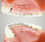 しろがね矯正歯科、姫路、矯正