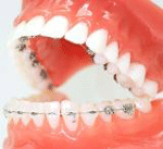 しろがね矯正歯科、姫路、矯正