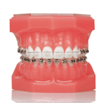 しろがね矯正歯科、姫路、矯正