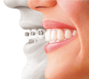 マウスピース型（カスタムメイド）矯正（歯科）装置