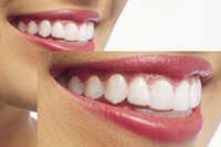 マウスピース型（カスタムメイド）矯正（歯科）装置